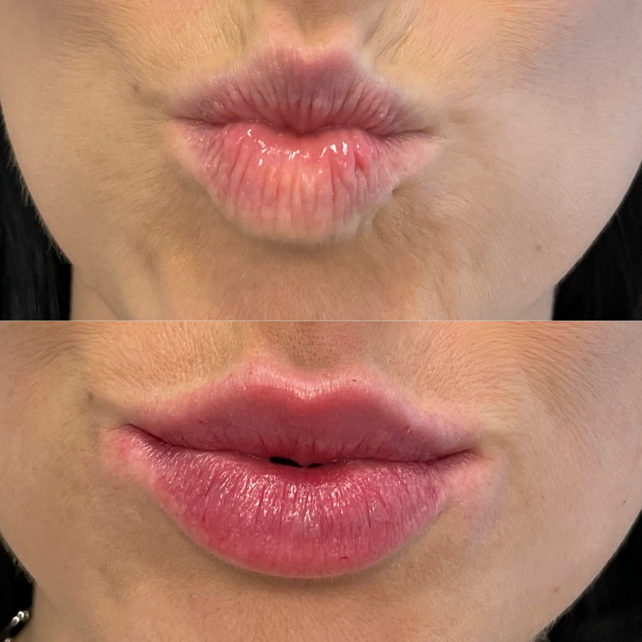 Lip Filler London: Natural Lip Enhancement & Lip Augmentation by Medical Experts