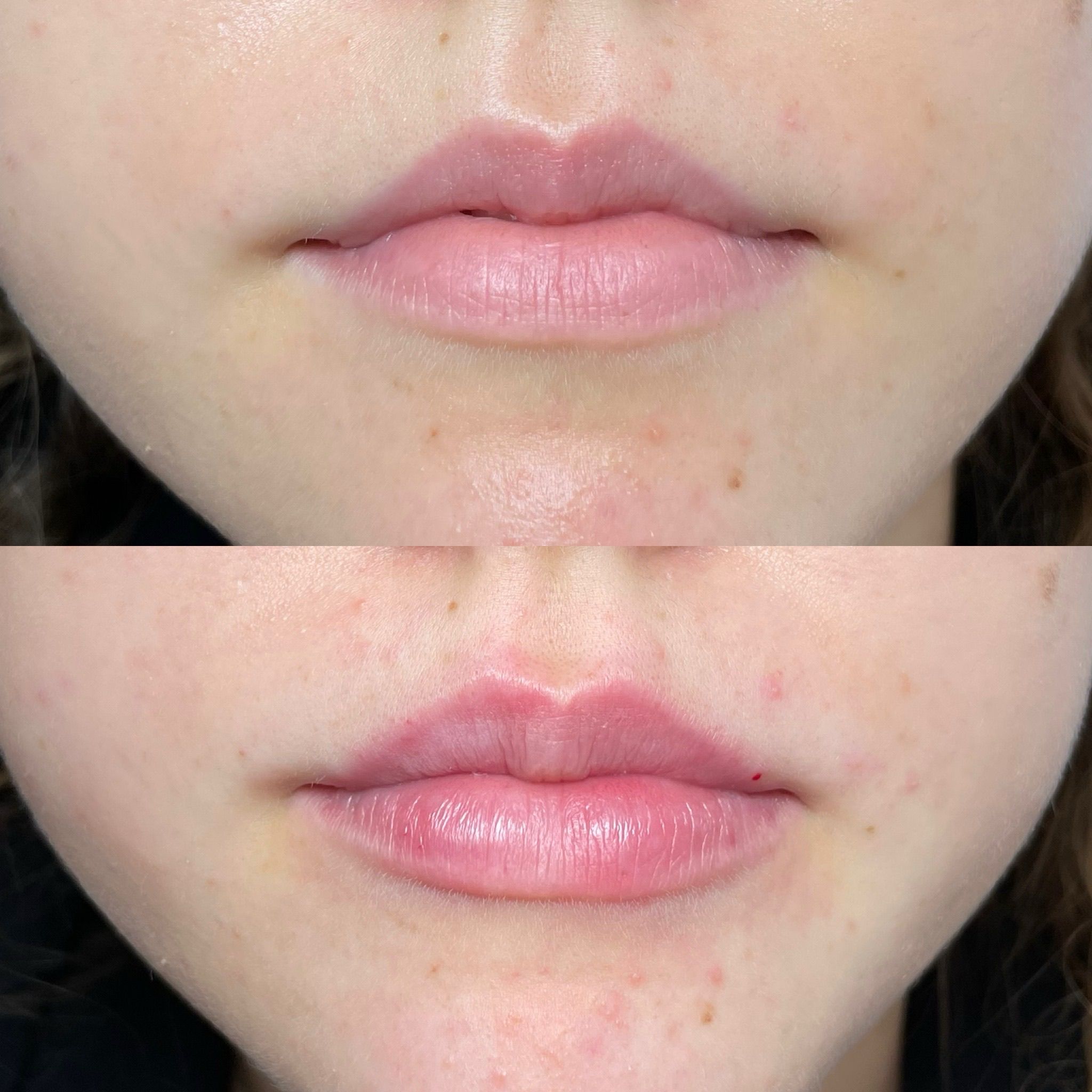 Lip Filler London: Natural Lip Enhancement & Lip Augmentation by Medical Experts